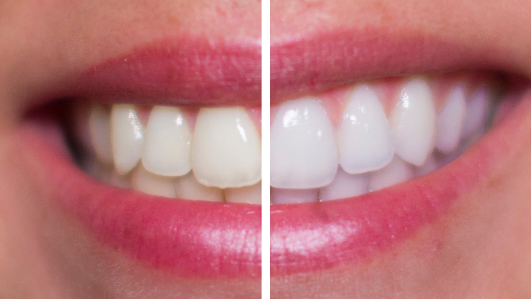 Is hydrogen peroxide teeth whitening