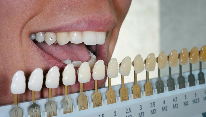 professional-teeth-whitening-faq-toothstars